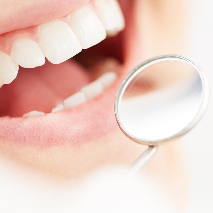 dental-cleaning