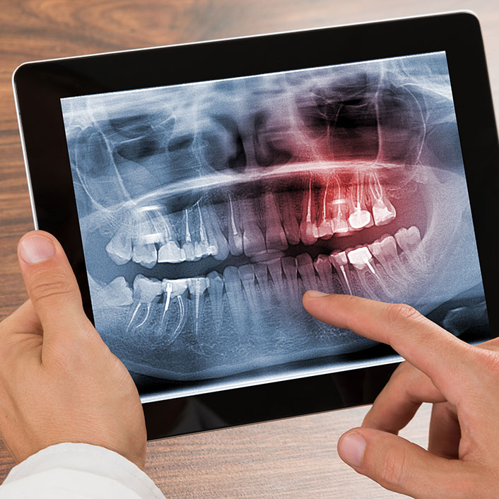 Digital Xray