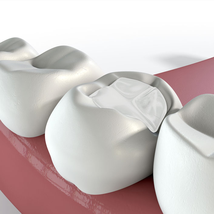 fillings