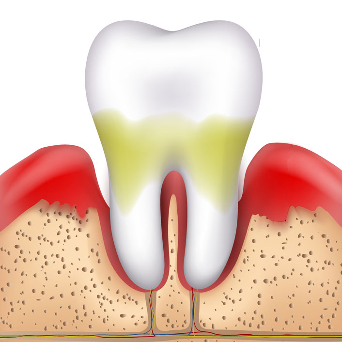 Gum Treatments