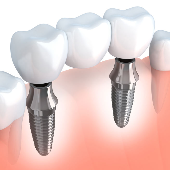 Dental Implants