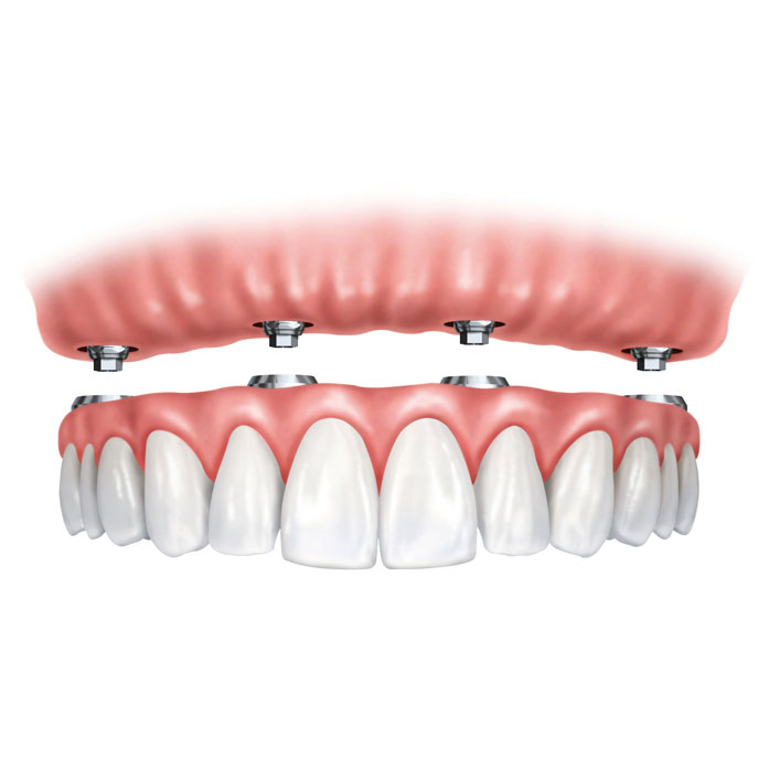 overdentures