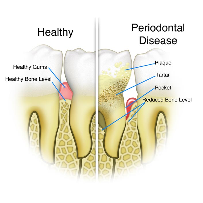 periodontal