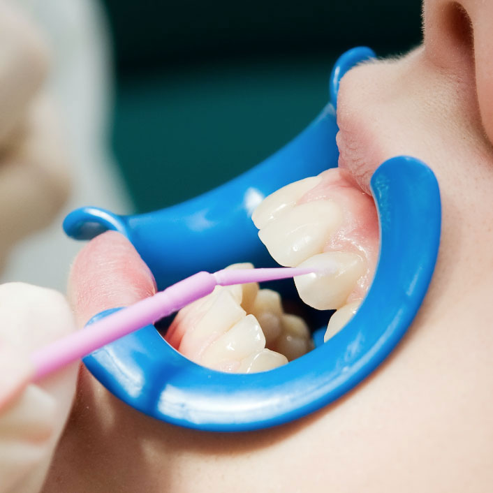 sealants