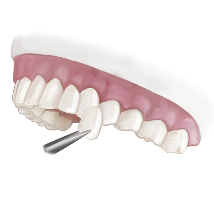 veneers