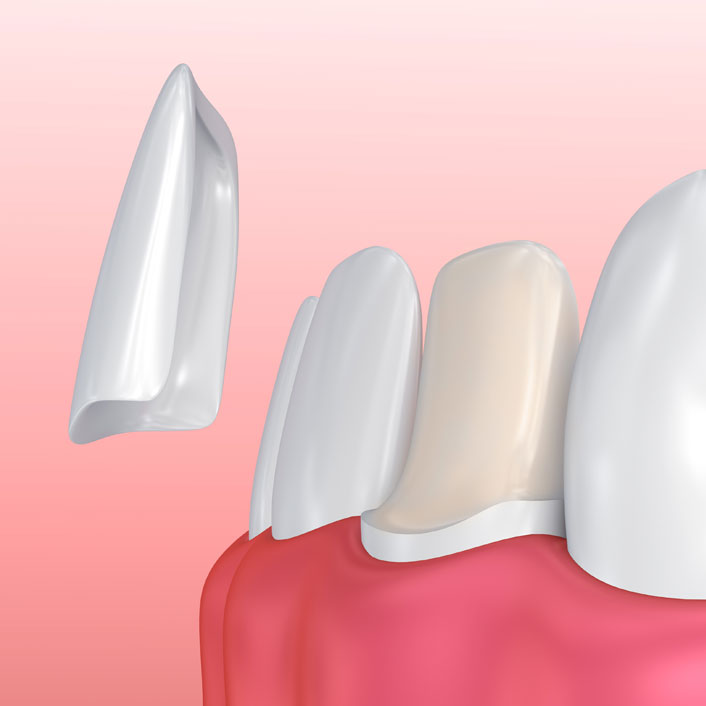 Veneers